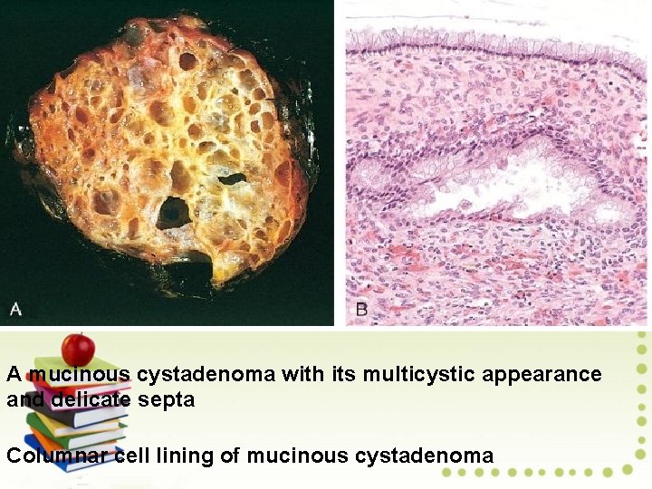 A mucinous cystadenoma with its multicystic appearance and delicate septa Columnar cell lining of