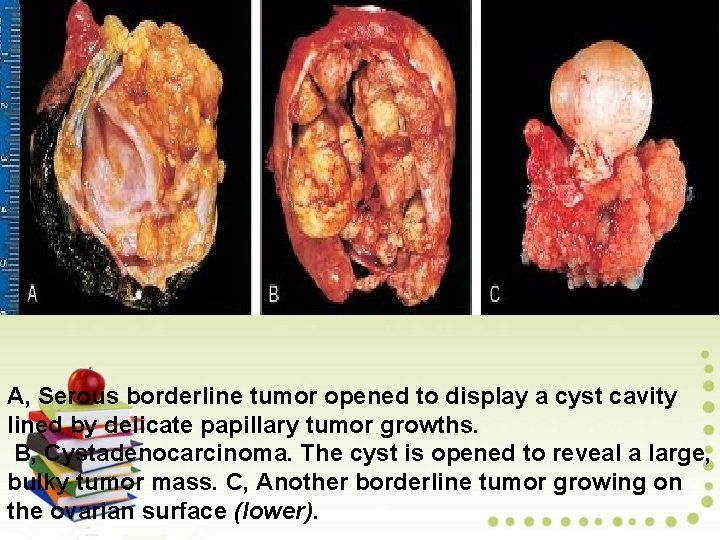 A, Serous borderline tumor opened to display a cyst cavity lined by delicate papillary