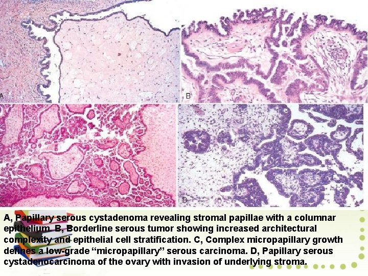 A, Papillary serous cystadenoma revealing stromal papillae with a columnar epithelium. B, Borderline serous