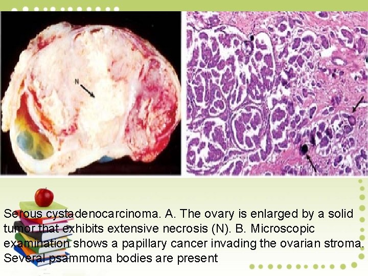 Serous cystadenocarcinoma. A. The ovary is enlarged by a solid tumor that exhibits extensive