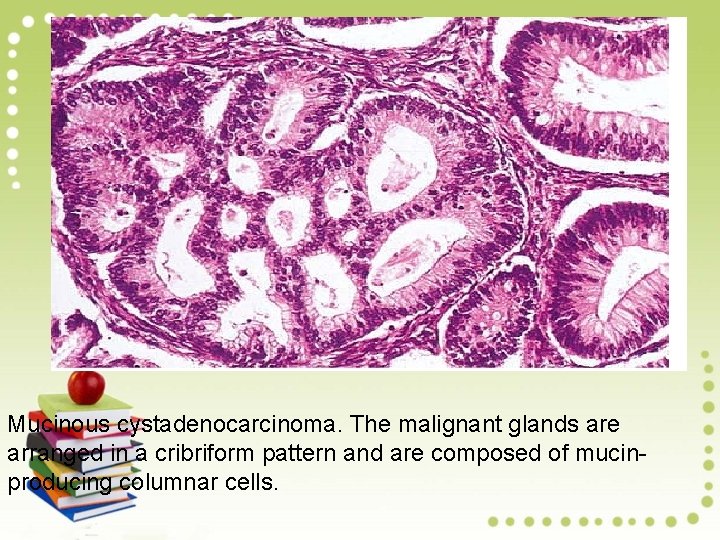 Mucinous cystadenocarcinoma. The malignant glands are arranged in a cribriform pattern and are composed