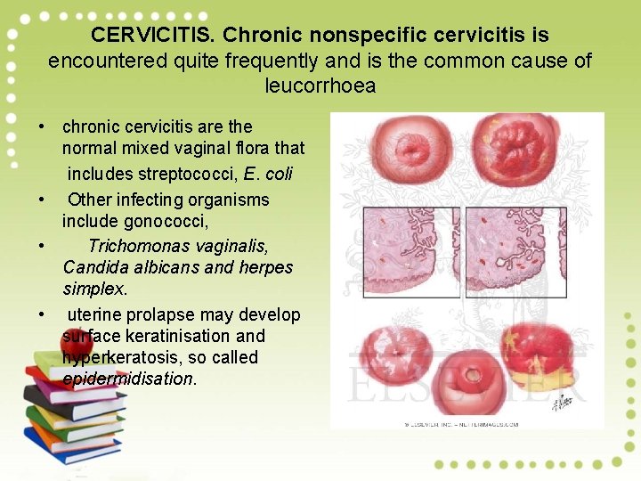 CERVICITIS. Chronic nonspecific cervicitis is encountered quite frequently and is the common cause of