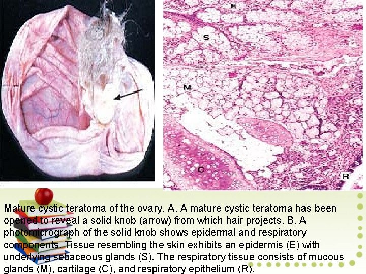 Mature cystic teratoma of the ovary. A. A mature cystic teratoma has been opened