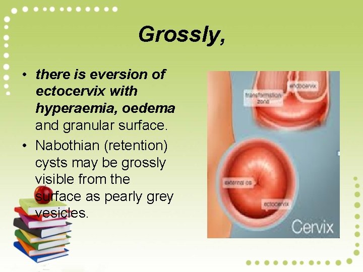 Grossly, • there is eversion of ectocervix with hyperaemia, oedema and granular surface. •