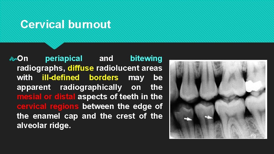 Cervical burnout On periapical and bitewing radiographs, diffuse radiolucent areas with ill-defined borders may