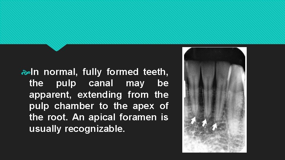  In normal, fully formed teeth, the pulp canal may be apparent, extending from