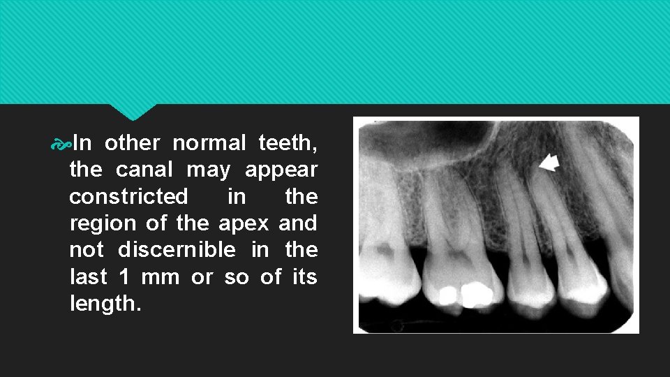  In other normal teeth, the canal may appear constricted in the region of