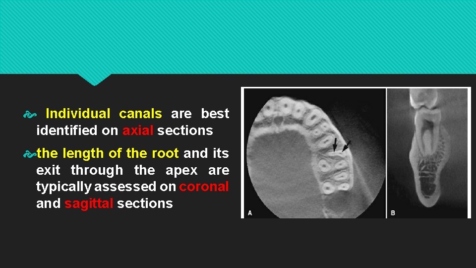  Individual canals are best identified on axial sections the length of the root