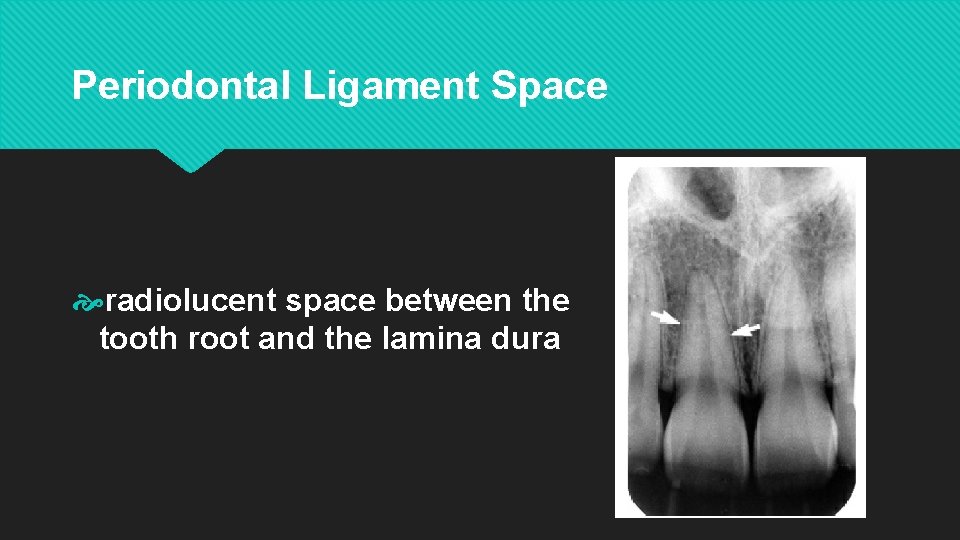 Periodontal Ligament Space radiolucent space between the tooth root and the lamina dura 