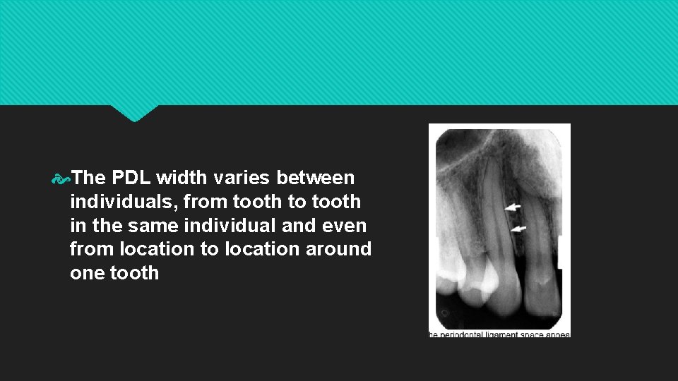  The PDL width varies between individuals, from tooth to tooth in the same