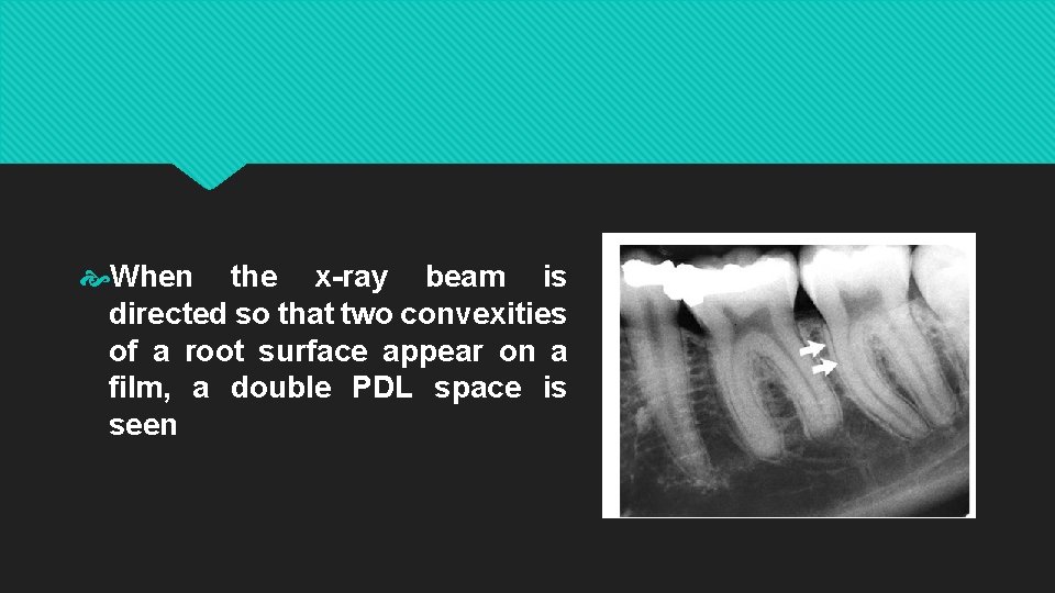  When the x-ray beam is directed so that two convexities of a root