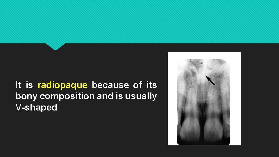 It is radiopaque because of its bony composition and is usually V-shaped 