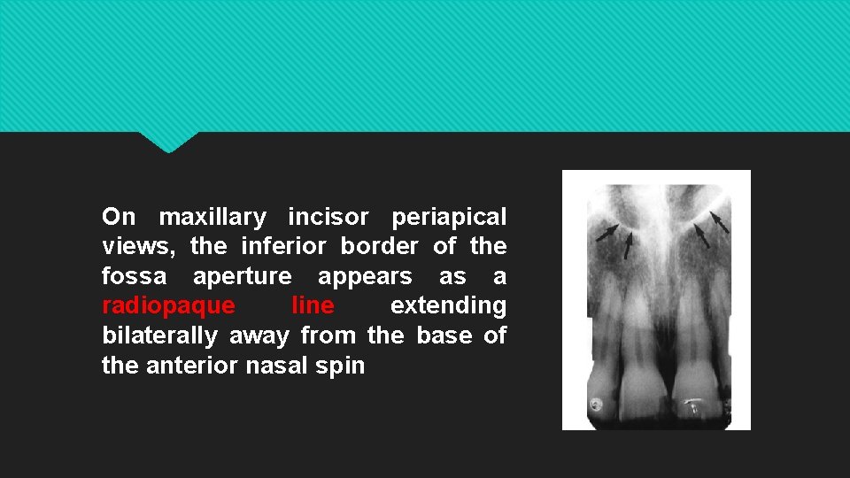 On maxillary incisor periapical views, the inferior border of the fossa aperture appears as