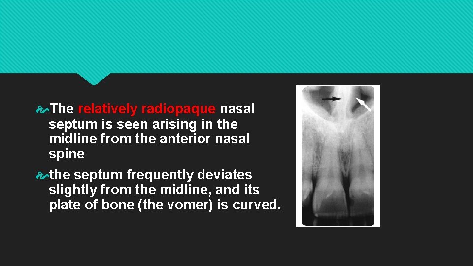  The relatively radiopaque nasal septum is seen arising in the midline from the