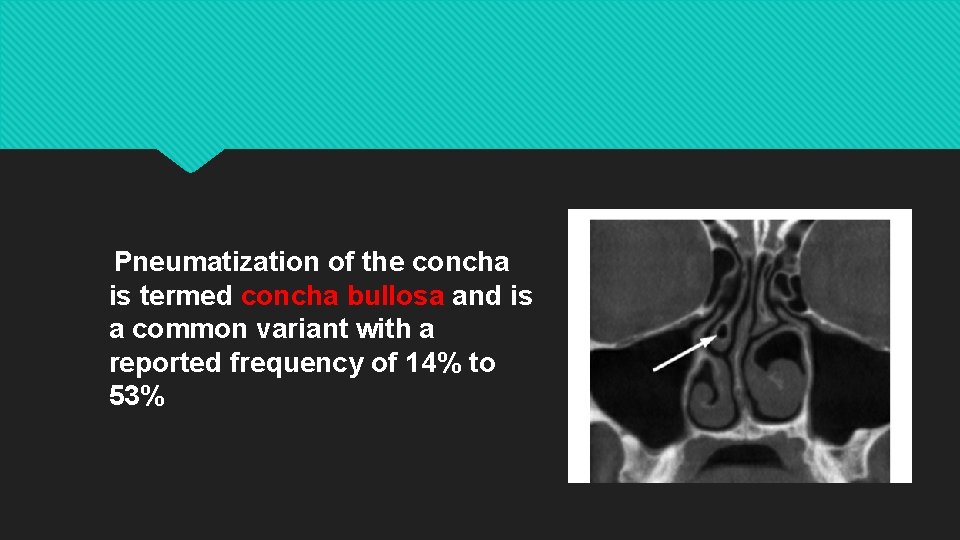 Pneumatization of the concha is termed concha bullosa and is a common variant with