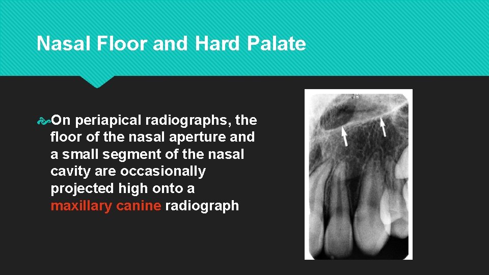 Nasal Floor and Hard Palate On periapical radiographs, the floor of the nasal aperture