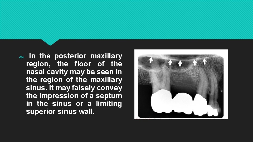  In the posterior maxillary region, the floor of the nasal cavity may be
