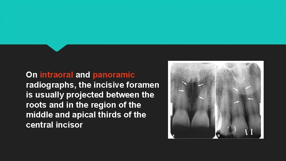 On intraoral and panoramic radiographs, the incisive foramen is usually projected between the roots