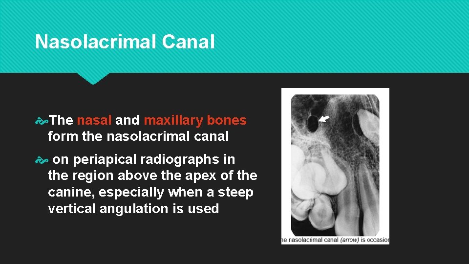 Nasolacrimal Canal The nasal and maxillary bones form the nasolacrimal canal on periapical radiographs