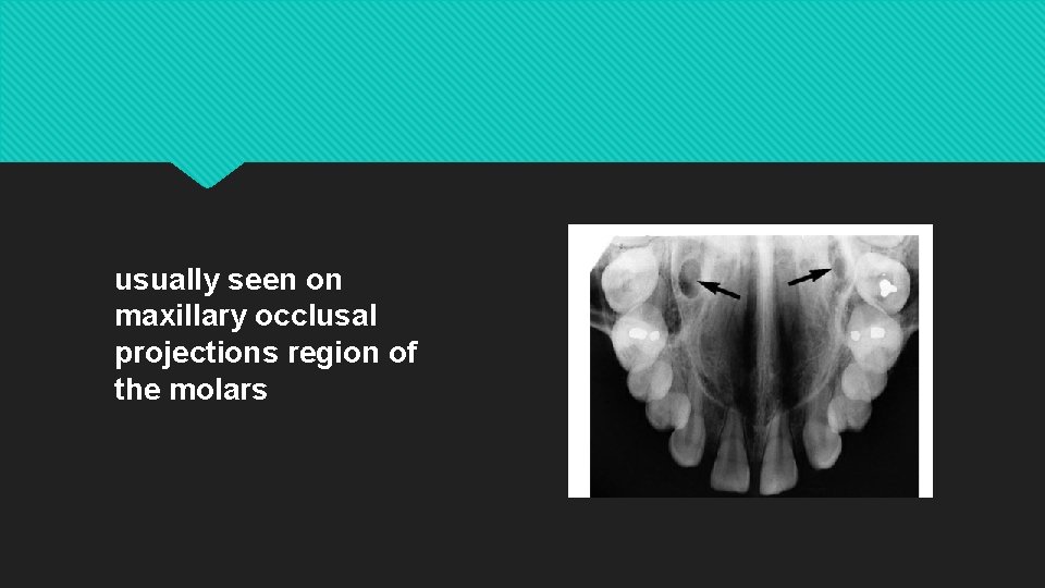 usually seen on maxillary occlusal projections region of the molars 