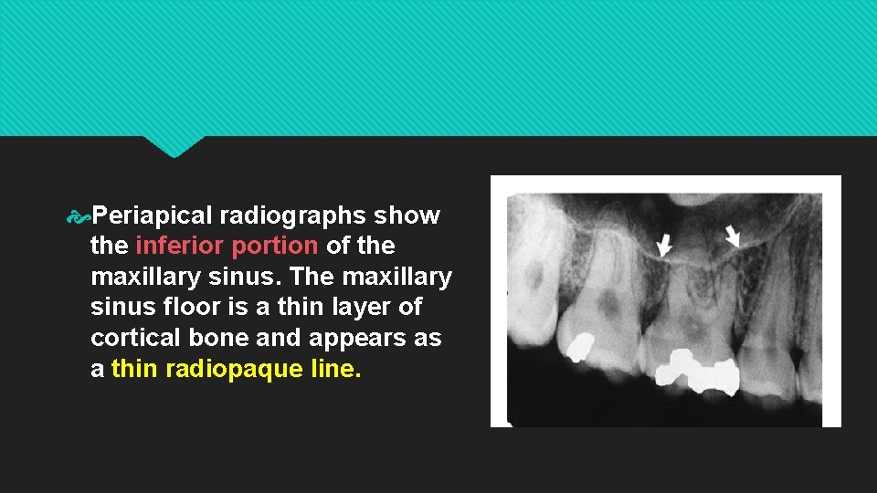  Periapical radiographs show the inferior portion of the maxillary sinus. The maxillary sinus