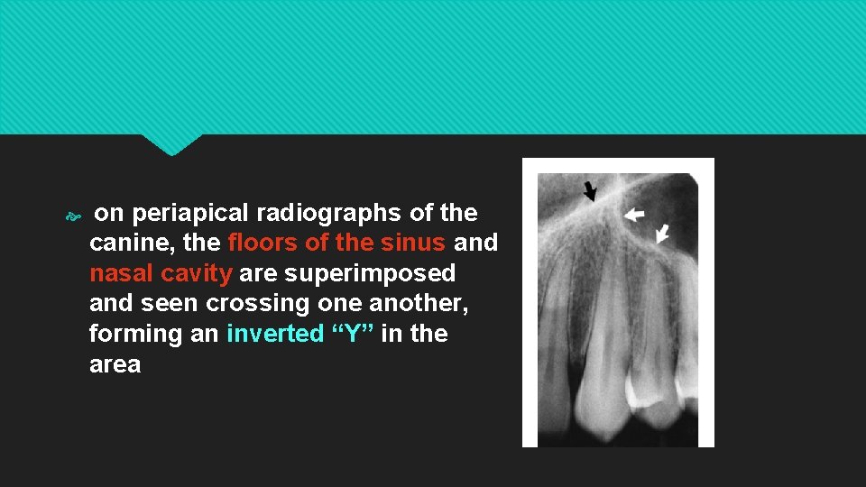  on periapical radiographs of the canine, the floors of the sinus and nasal