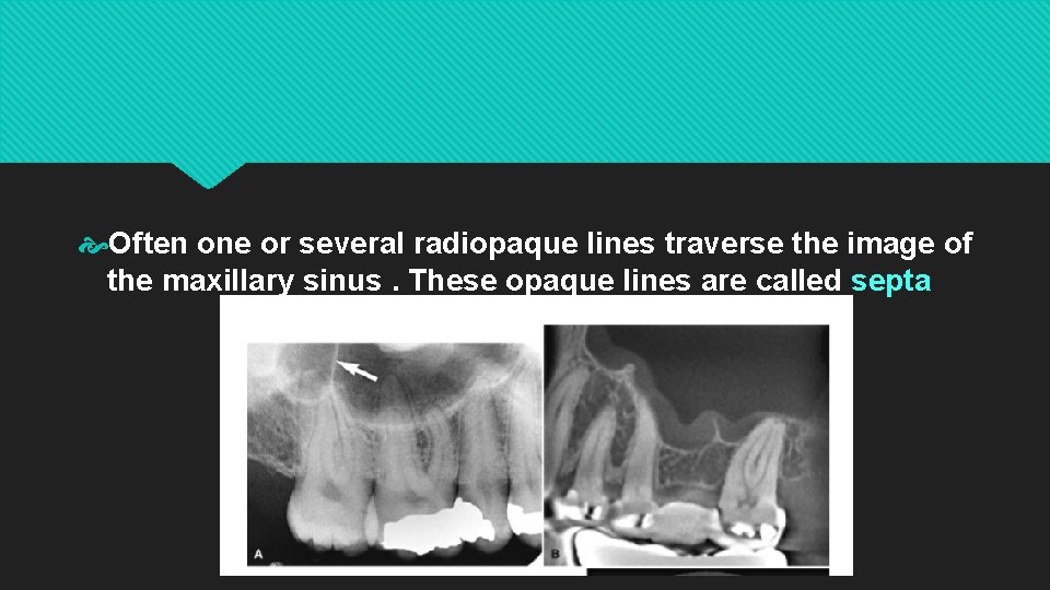  Often one or several radiopaque lines traverse the image of the maxillary sinus.