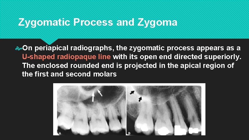 Zygomatic Process and Zygoma On periapical radiographs, the zygomatic process appears as a U-shaped