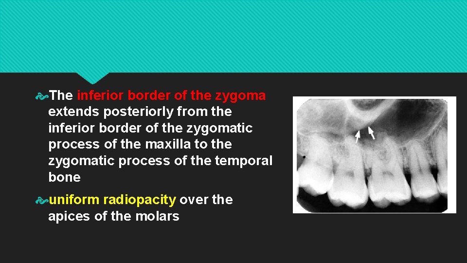  The inferior border of the zygoma extends posteriorly from the inferior border of