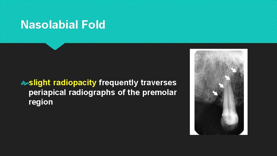 Nasolabial Fold slight radiopacity frequently traverses periapical radiographs of the premolar region 