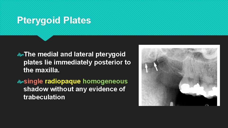 Pterygoid Plates The medial and lateral pterygoid plates lie immediately posterior to the maxilla.