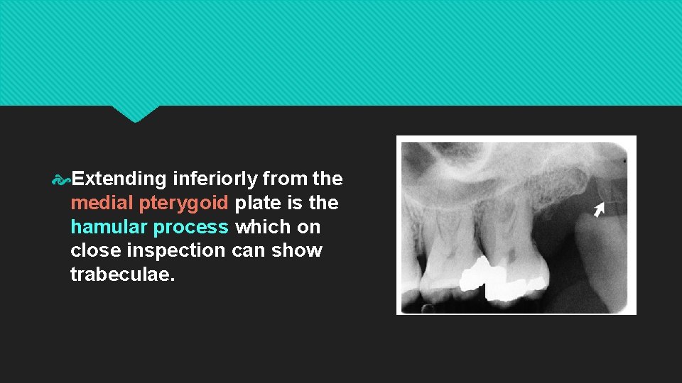  Extending inferiorly from the medial pterygoid plate is the hamular process which on