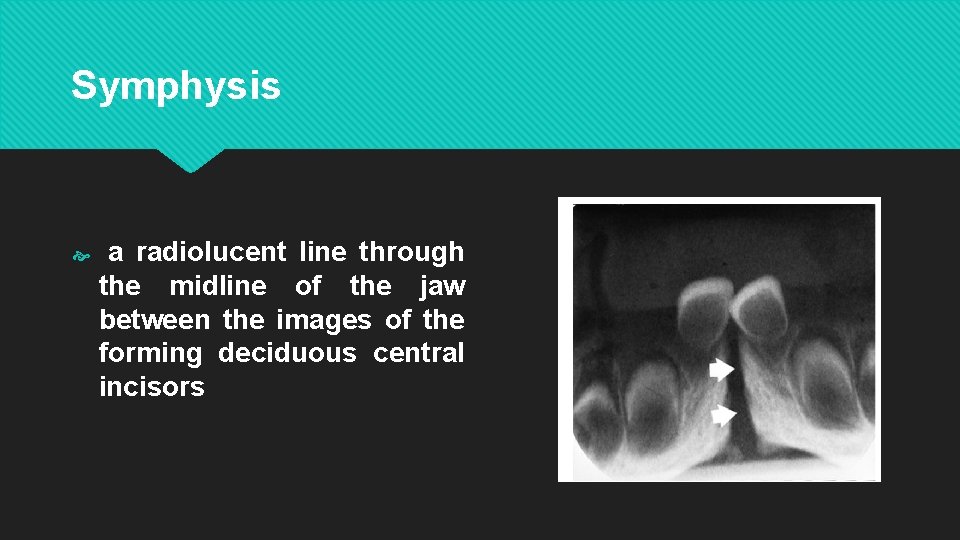 Symphysis a radiolucent line through the midline of the jaw between the images of