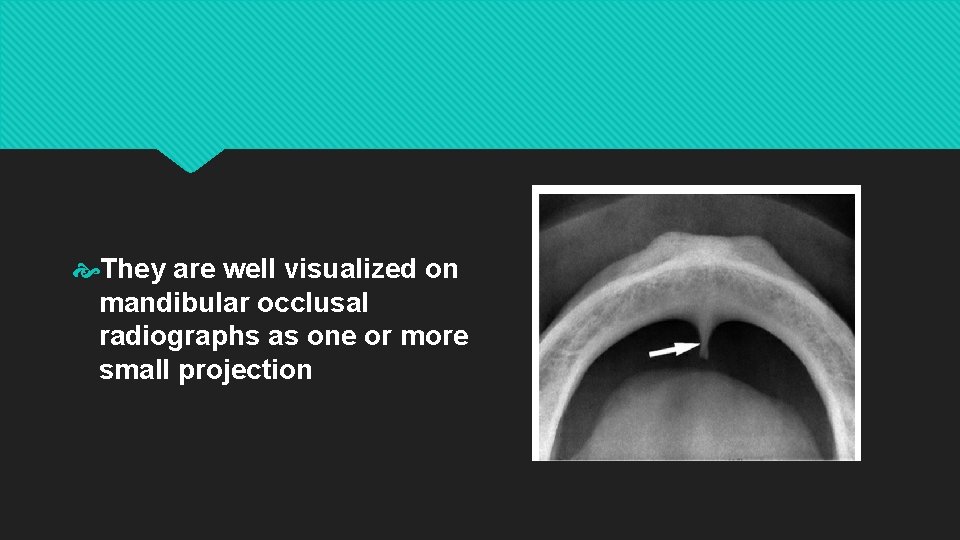  They are well visualized on mandibular occlusal radiographs as one or more small