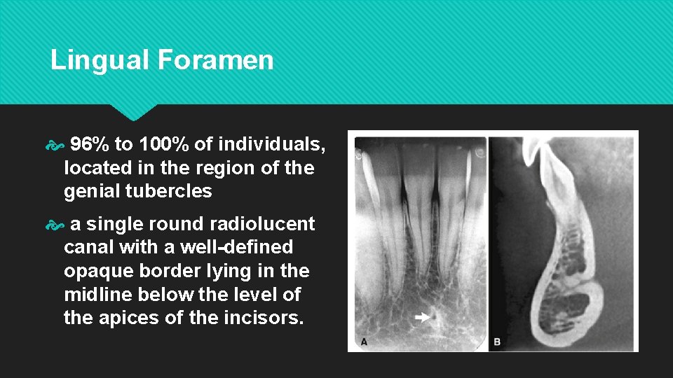 Lingual Foramen 96% to 100% of individuals, located in the region of the genial