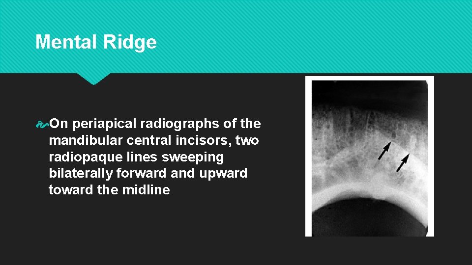 Mental Ridge On periapical radiographs of the mandibular central incisors, two radiopaque lines sweeping