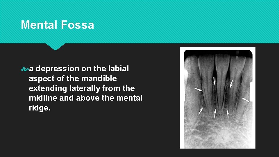 Mental Fossa a depression on the labial aspect of the mandible extending laterally from