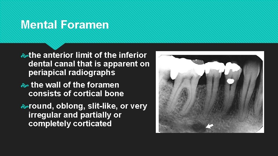 Mental Foramen the anterior limit of the inferior dental canal that is apparent on