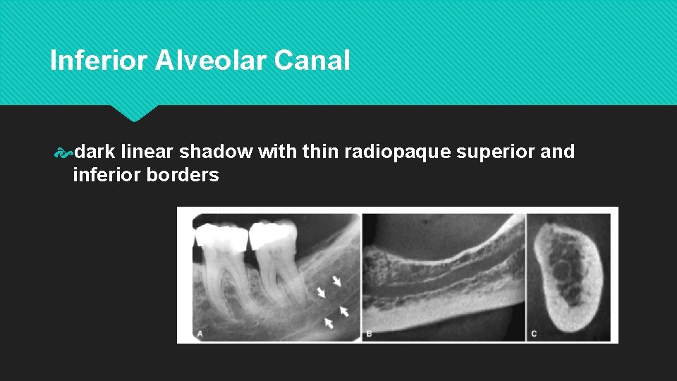 Inferior Alveolar Canal dark linear shadow with thin radiopaque superior and inferior borders 