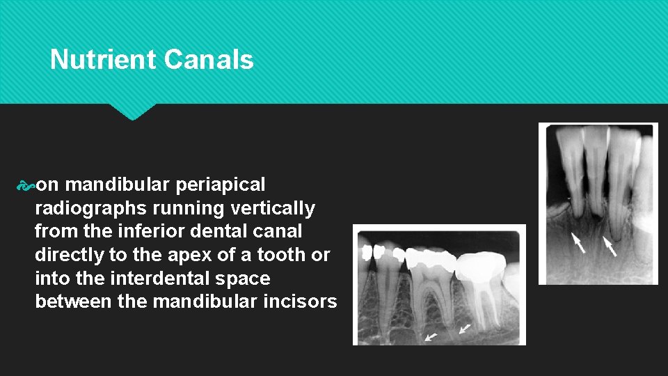 Nutrient Canals on mandibular periapical radiographs running vertically from the inferior dental canal directly