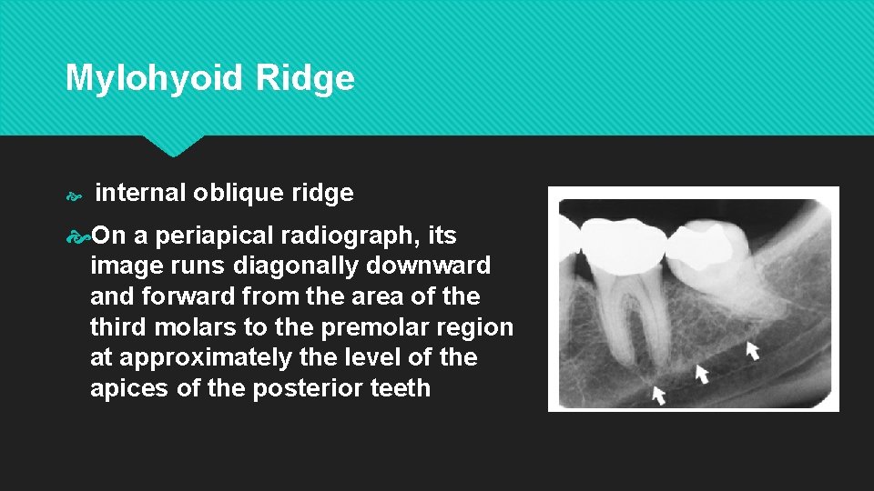 Mylohyoid Ridge internal oblique ridge On a periapical radiograph, its image runs diagonally downward