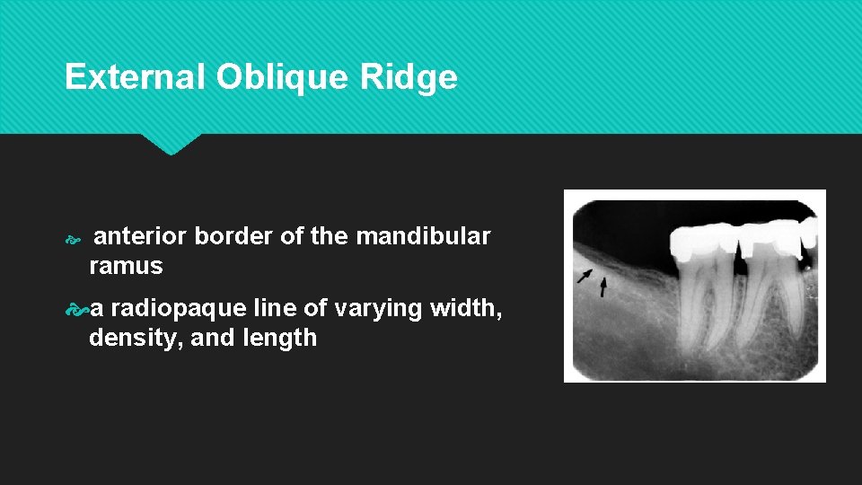 External Oblique Ridge anterior border of the mandibular ramus a radiopaque line of varying
