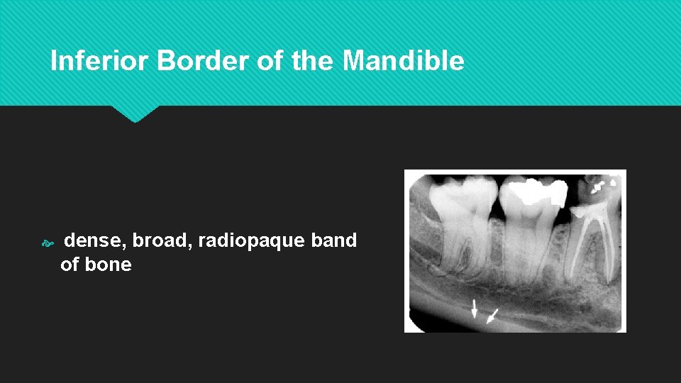 Inferior Border of the Mandible dense, broad, radiopaque band of bone 