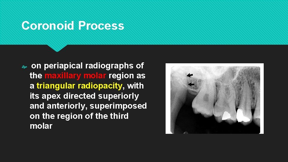 Coronoid Process on periapical radiographs of the maxillary molar region as a triangular radiopacity,