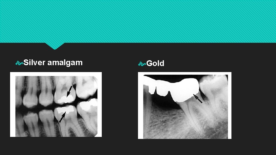  Silver amalgam Gold 