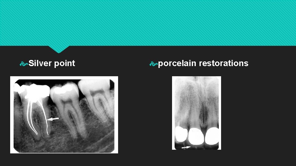 Silver point porcelain restorations 
