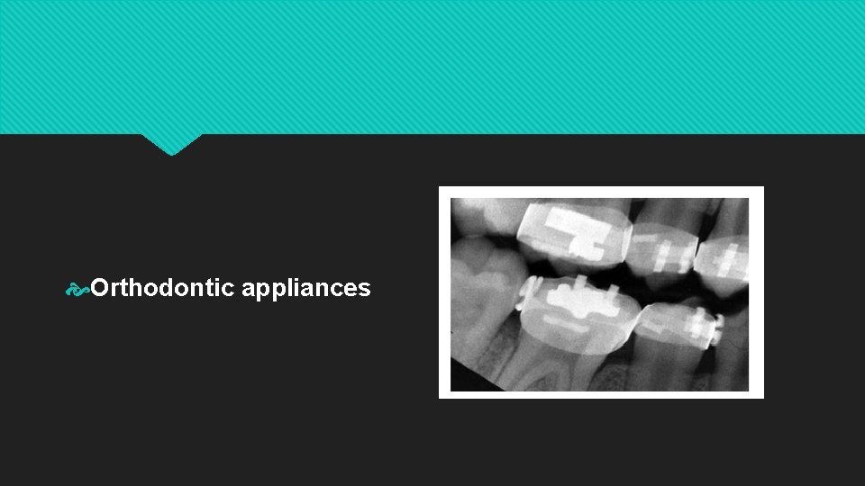  Orthodontic appliances 