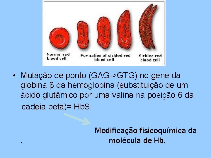  • Mutação de ponto (GAG->GTG) no gene da globina β da hemoglobina (substituição