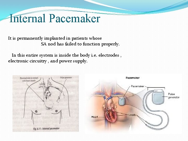 Internal Pacemaker It is permanently implanted in patients whose SA nod has failed to