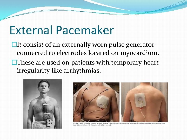 External Pacemaker �It consist of an externally worn pulse generator connected to electrodes located